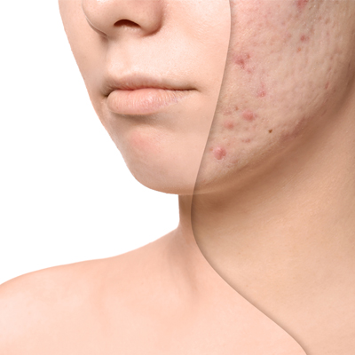 درمان اسكار آكنه Image